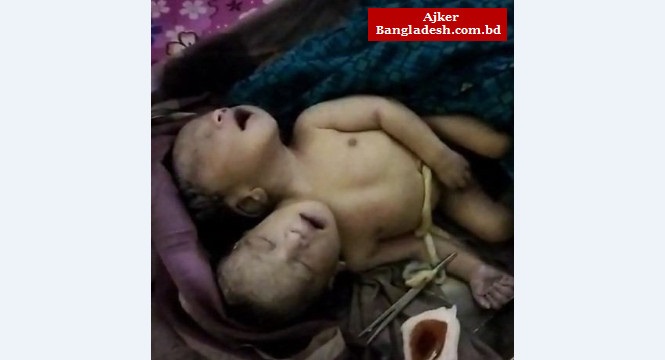 বাগআঁচড়ায় দুই মাথা নিয়ে শিশুর জন্ম বাগআঁচড়ায় দুই মাথা নিয়ে শিশুর জন্ম